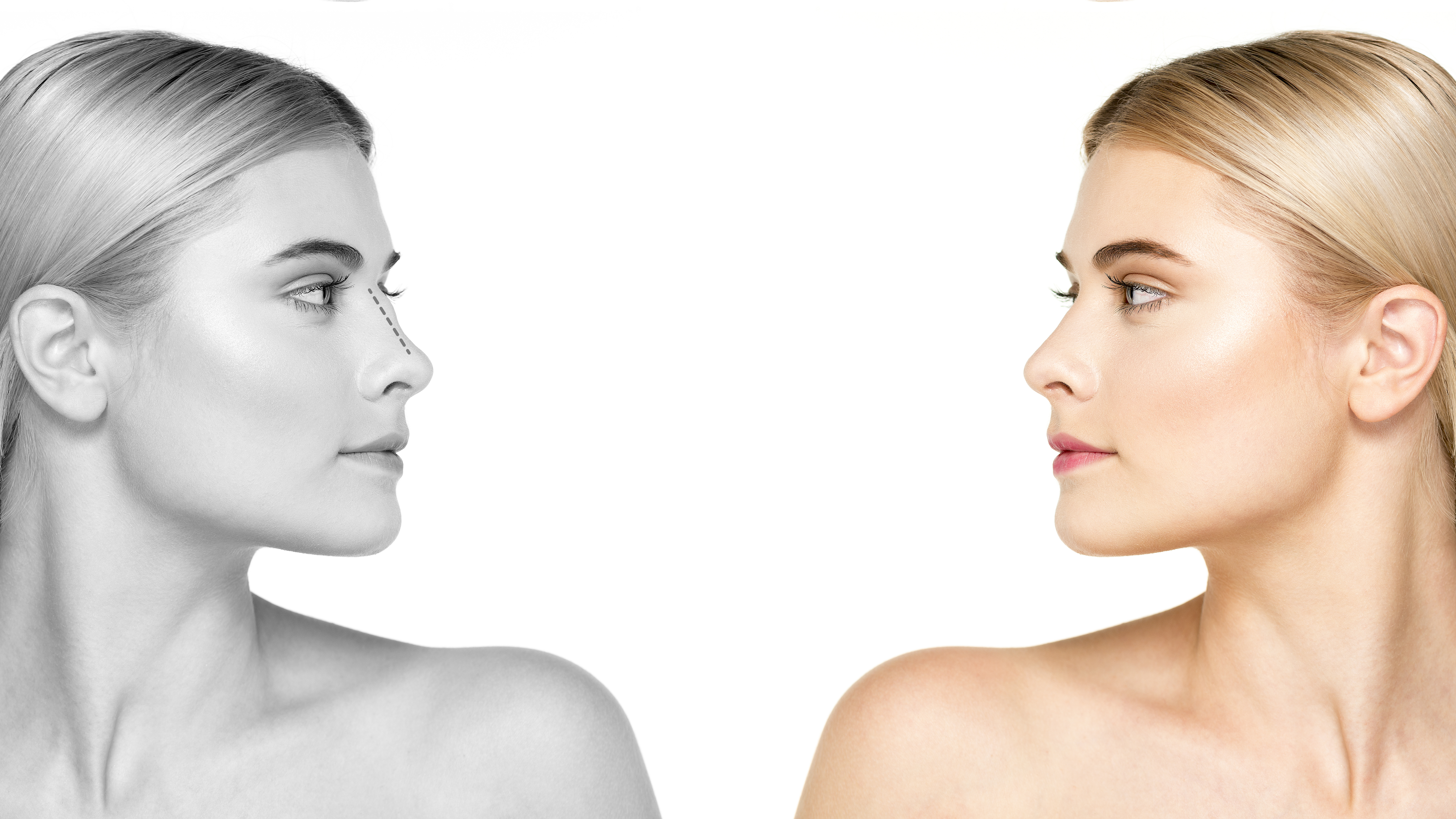 side-view-woman-before-and-after-rhinoplasty